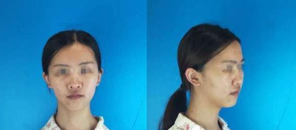 濱州醫(yī)學院附屬醫(yī)院做隆鼻術(shù)前效果 濱州醫(yī)學院附屬醫(yī)院做隆鼻術(shù)前效果