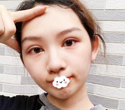 武漢伊萊美割雙眼皮案例分享術后一周效果 武漢伊萊美割雙眼皮案例分享術后一周效果