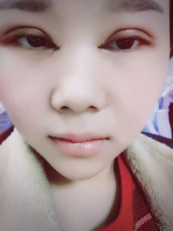 汕頭曙光雙眼皮手術(shù)當(dāng)天 汕頭曙光雙眼皮手術(shù)當(dāng)天