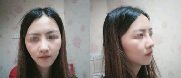濱州醫(yī)學院附屬醫(yī)院做隆鼻一個月效果 濱州醫(yī)學院附屬醫(yī)院做隆鼻一個月效果