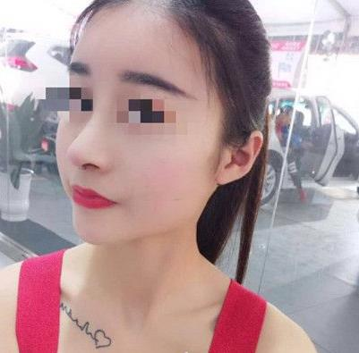 石家莊諾萬整形姚華榮硅膠隆鼻效果分享，同款酒糟鼻值得一試