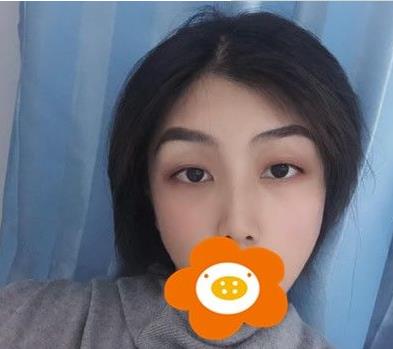 溫州韓美周杰群醫(yī)生耳軟骨隆鼻案例分享術(shù)后一個月效果 溫州韓美周杰群醫(yī)生耳軟骨隆鼻案例分享術(shù)后一個月效果