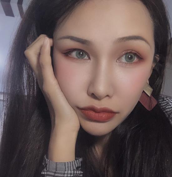 長(zhǎng)春中研整形黃帝云鼻頭縮小案例術(shù)后三個(gè)月效果