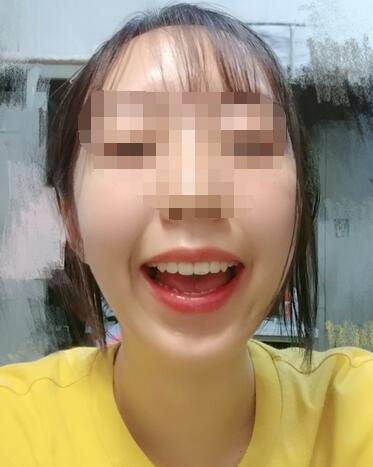 昆山禾豐口腔牙齒矯正案例牙齒矯正結(jié)束 昆山禾豐口腔牙齒矯正案例牙齒矯正結(jié)束