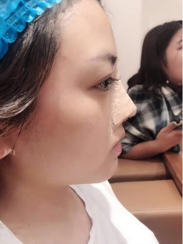 廈門海峽整形鼻綜合案例術(shù)后第二天 廈門海峽整形鼻綜合案例術(shù)后第二天