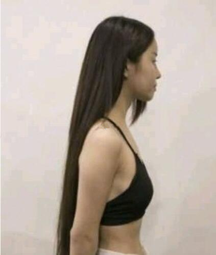 濟(jì)南海峽整形假體隆胸術(shù)前效果 濟(jì)南海峽整形假體隆胸術(shù)前效果