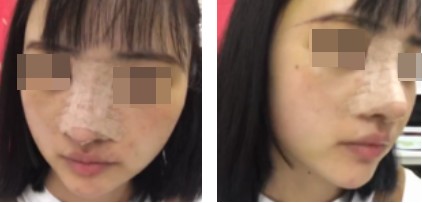 哈爾濱成美整形周小生鼻綜合案例術后兩天 哈爾濱成美整形周小生鼻綜合案例術后兩天