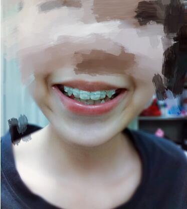 昆山禾豐口腔牙齒矯正案例牙齒即將排齊 昆山禾豐口腔牙齒矯正案例牙齒即將排齊