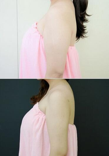 揭陽美萊整形手臂吸脂案例分享，輕松告別拜拜肉