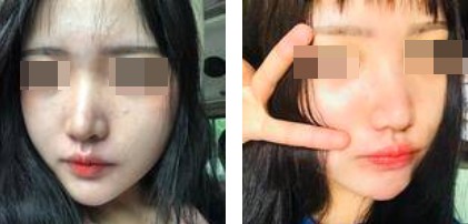 哈爾濱成美整形周小生鼻綜合案例前后對比圖 哈爾濱成美整形周小生鼻綜合案例前后對比圖