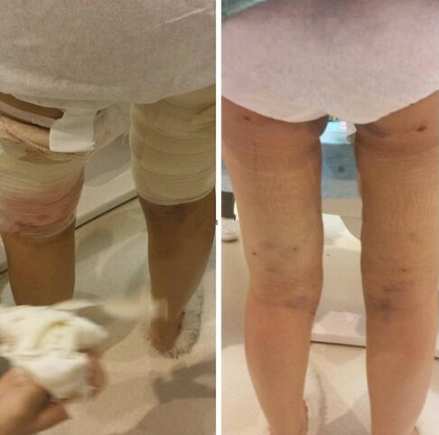 成都趙博士整形大腿吸脂案例術后即刻效果 成都趙博士整形大腿吸脂案例術后即刻效果