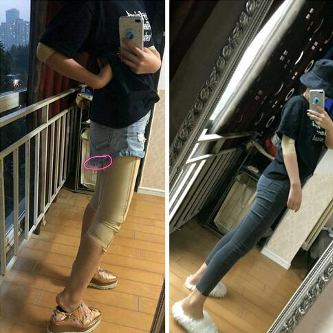 成都趙博士整形大腿吸脂案例一個月效果 成都趙博士整形大腿吸脂案例一個月效果