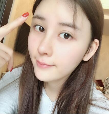 這么好的效果，不來蘭州美月做膨體隆鼻真是白瞎了醫(yī)生的技術(shù)