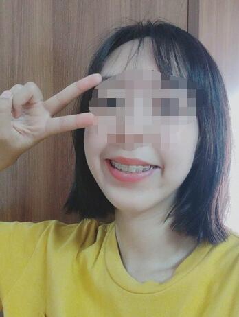 昆山禾豐口腔牙齒矯正案例進(jìn)入牙齒穩(wěn)固階段 昆山禾豐口腔牙齒矯正案例進(jìn)入牙齒穩(wěn)固階段