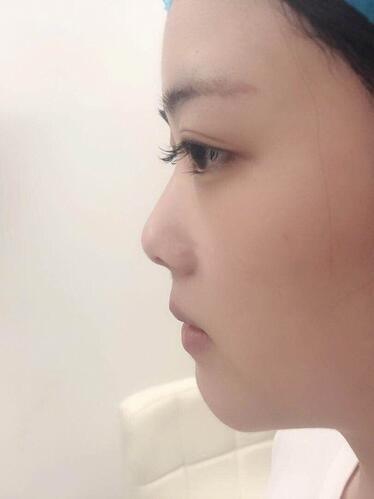 廈門海峽整形鼻綜合案例術(shù)前效果 廈門海峽整形鼻綜合案例術(shù)前效果