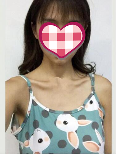 濟(jì)南美爾雅整形自體脂肪隆胸術(shù)前效果 濟(jì)南美爾雅整形自體脂肪隆胸術(shù)前效果