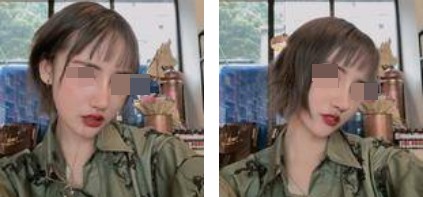 哈爾濱成美整形周小生鼻綜合案例術后兩個月 哈爾濱成美整形周小生鼻綜合案例術后兩個月