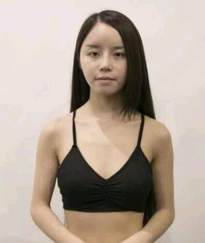 福州海峽假體隆胸案例術(shù)前 福州海峽假體隆胸案例術(shù)前