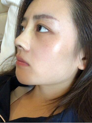 廈門海峽整形鼻綜合案例術(shù)后一個(gè)月 廈門海峽整形鼻綜合案例術(shù)后一個(gè)月