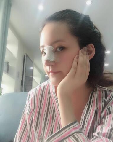 北京葉子整形肋軟骨隆鼻案例手術(shù)當(dāng)天側(cè)面 北京葉子整形肋軟骨隆鼻案例手術(shù)當(dāng)天側(cè)面