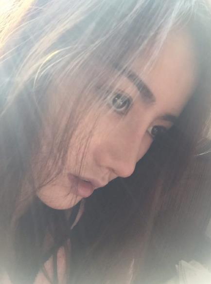 北京藝美整形鼻綜合案例術(shù)后一個(gè)月