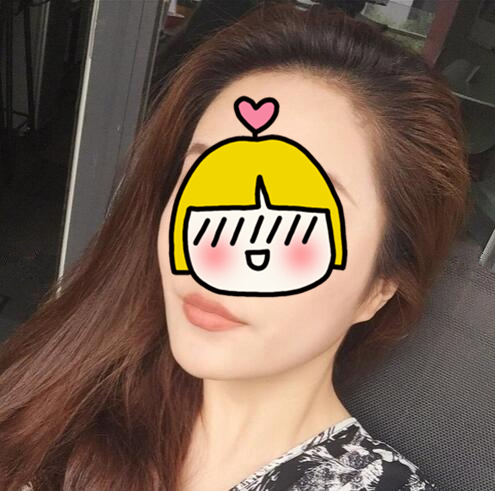 南京藝星整形趙海波面部吸脂術(shù)后一個月 南京藝星整形趙海波面部吸脂術(shù)后一個月