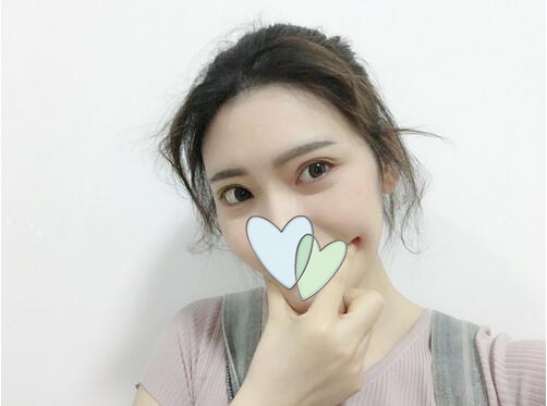 哈爾濱成美自體脂肪全臉填充案例術后三個月 哈爾濱成美自體脂肪全臉填充案例術后三個月