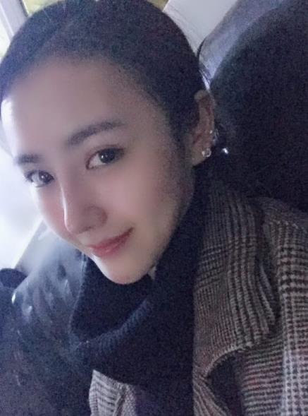 北京藝美整形鼻綜合案例術(shù)后兩個(gè)月