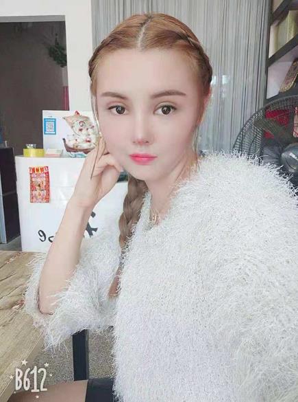 長沙雅美眼鼻整形案例術(shù)后一個(gè)月效果 長沙雅美眼鼻整形案例術(shù)后一個(gè)月效果