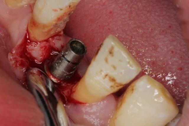 深圳正夫口腔種植牙案例術(shù)中 深圳正夫口腔種植牙案例術(shù)中