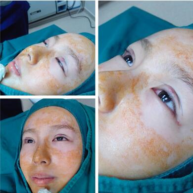 萍鄉(xiāng)麗芙整形埋線雙眼皮三個月效果分享，完全看不出來是做的