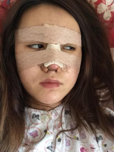 北京藝美整形鼻綜合案例術(shù)后第二天