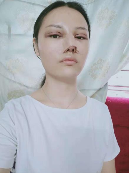 長沙雅美眼鼻整形案例術(shù)后第二天效果 長沙雅美眼鼻整形案例術(shù)后第二天效果