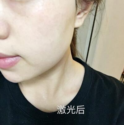 紹興維美整形激光祛斑兩個(gè)療程，皮膚像剝了殼的雞蛋