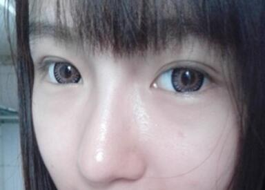 萍鄉(xiāng)麗芙整形埋線雙眼皮三個月效果分享，完全看不出來是做的