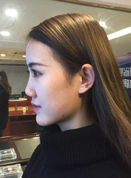 北京藝美整形鼻綜合案例術(shù)前