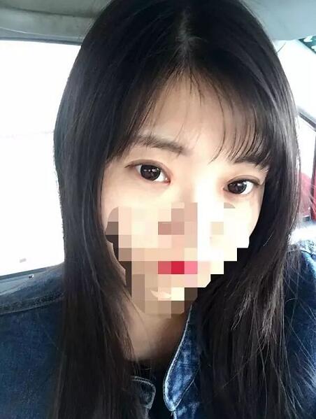 北京京民雙眼皮修復(fù)案例術(shù)后兩個月 北京京民雙眼皮修復(fù)案例術(shù)后兩個月