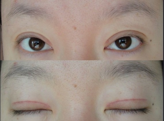 鄭州望京做全切雙眼皮+開外眼角半個月 鄭州望京做全切雙眼皮+開外眼角半個月