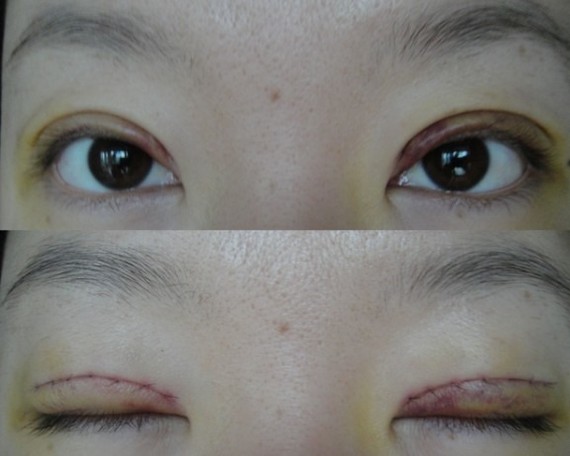 鄭州望京做全切雙眼皮+開外眼角術(shù)后一周 鄭州望京做全切雙眼皮+開外眼角術(shù)后一周