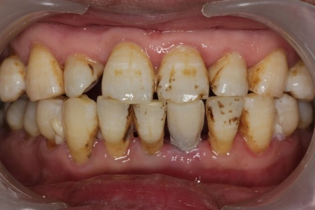 深圳正夫口腔種植牙案例分享，這下可以好好吃飯了