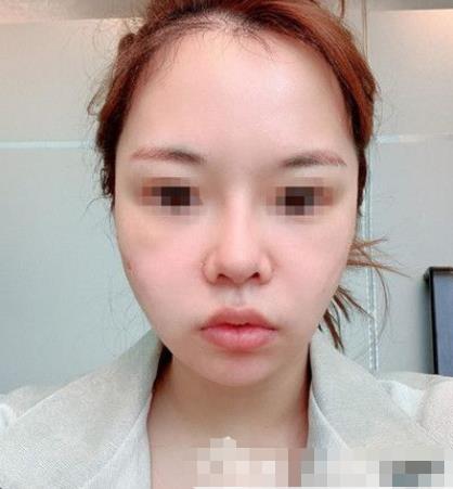 南京閱顏整形瘦臉針注射后三天 南京閱顏整形瘦臉針注射后三天