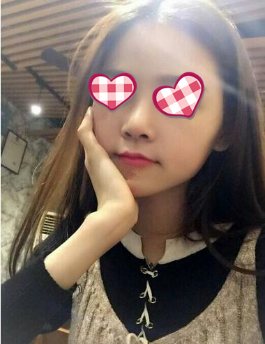 北京葉子整形膨體隆鼻術(shù)后三個月效果 北京葉子整形膨體隆鼻術(shù)后三個月效果