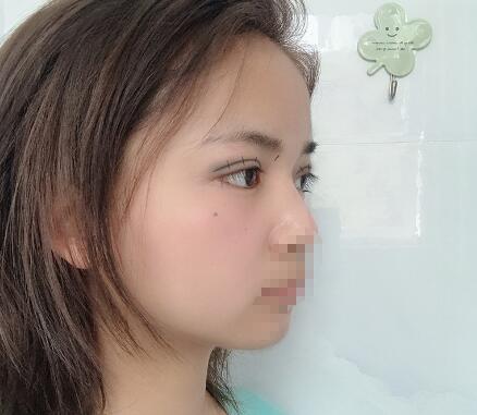 長(zhǎng)沙愛思特整形定點(diǎn)雙眼皮5天 長(zhǎng)沙愛思特整形定點(diǎn)雙眼皮5天