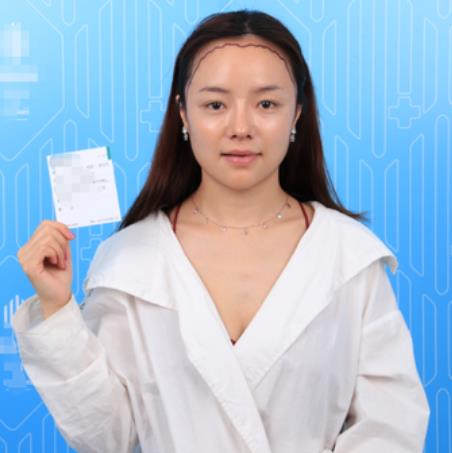 廈門新生植發(fā)種植發(fā)際線半年效果分享，一鍵get高顱頂