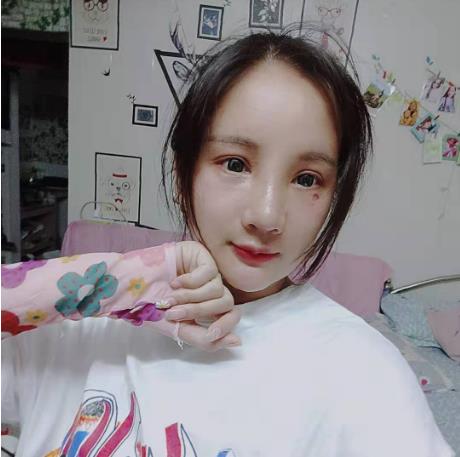 天津文怡整形水光針注射一周 天津文怡整形水光針注射一周