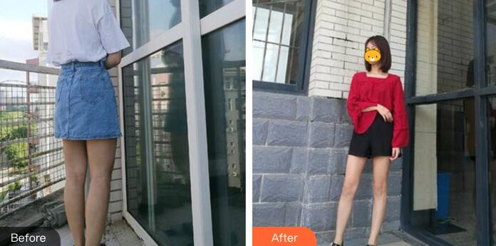 中山美南華整形大腿吸脂前后對(duì)比圖 中山美南華整形大腿吸脂前后對(duì)比圖
