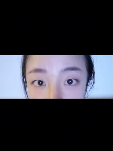 西安時(shí)光整形郭淑華雙眼皮案例分享，一個(gè)月就這么自然