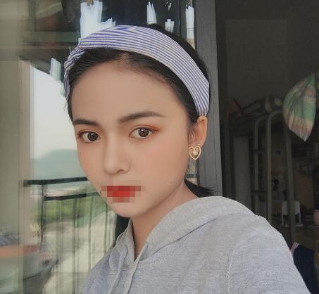 長(zhǎng)沙愛思特整形定點(diǎn)雙眼皮一個(gè)月 長(zhǎng)沙愛思特整形定點(diǎn)雙眼皮一個(gè)月