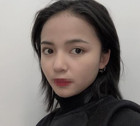 長沙愛思特整形定點雙眼皮案例分享，蘿莉到御姐的轉(zhuǎn)變