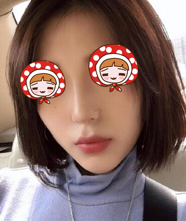 青島華諾整形歪鼻矯正術后兩個月效果 青島華諾整形歪鼻矯正術后兩個月效果